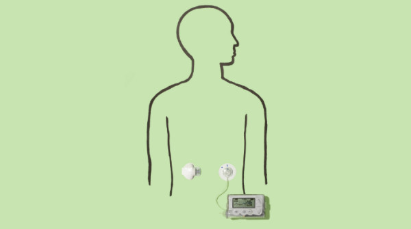 Un sostituto del pancreas
